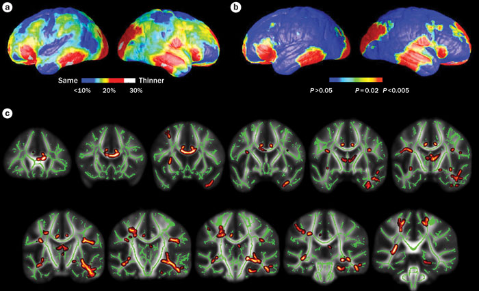 diffusion-weighted MRI